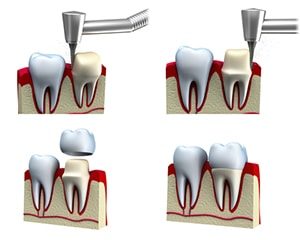 dental implants kennewick, wa