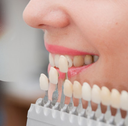 teeth whitening in kennewick, wa