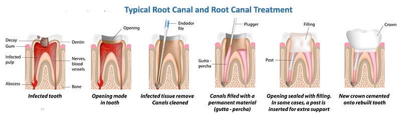 root canal dentist kennewick wa