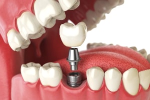 dental implants in kennewick, wa