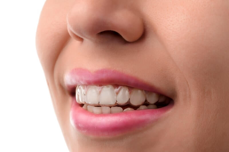 invisible braces in kennewick, wa