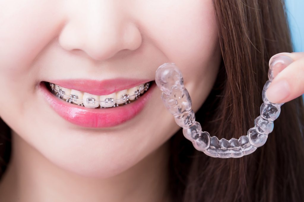 invisible braces in kennewick, wa