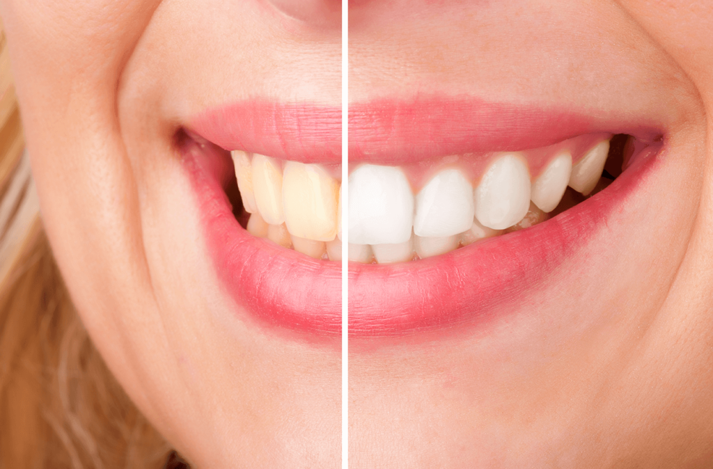 teeth whitening kennewick, wa